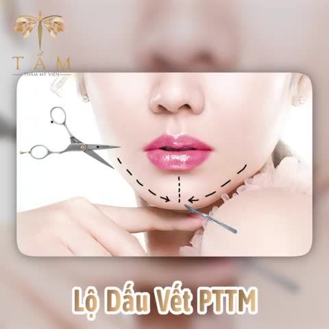 Nhẹ nhàng vượt qua nỗi sợ PTTM cùng Filler tại Tấm